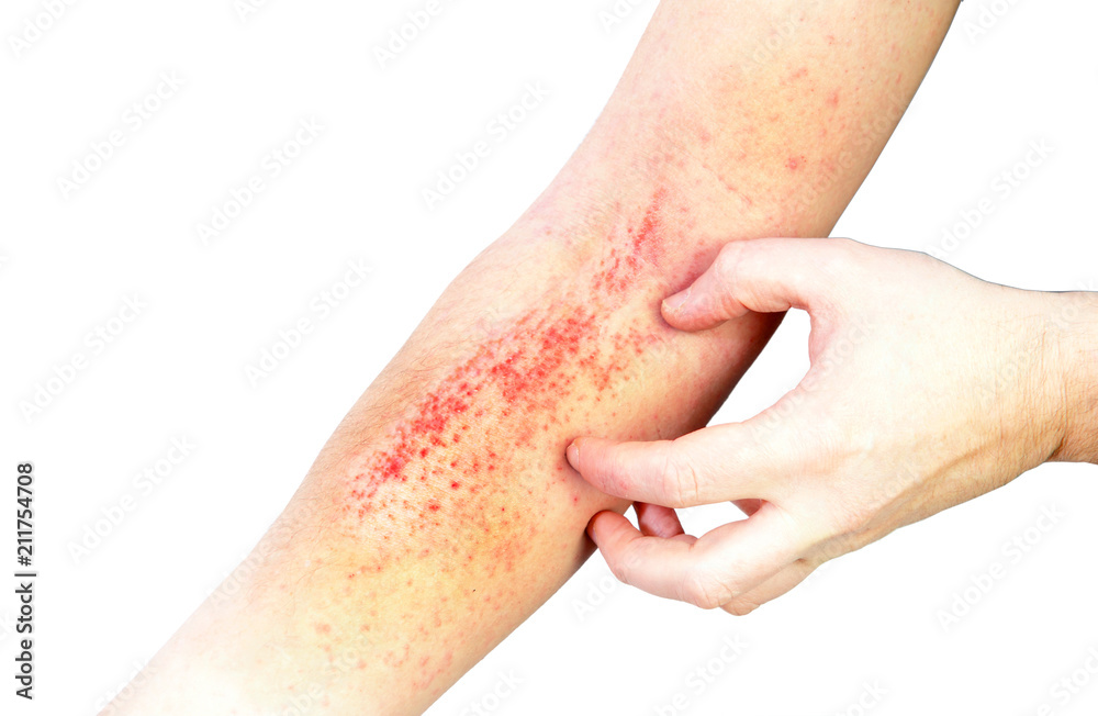 Atopic dermatitis (AD), also known as atopic eczema, is a type of ...