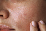 pores on the skin of the face. Cleansing the face skin