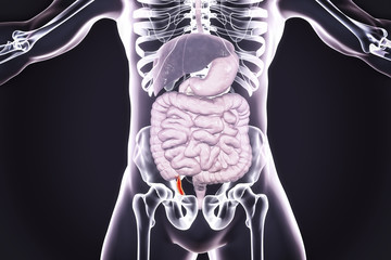 Canvas Print - Acute appendicitis, 3D illustration showing inflammed appendix inside human body