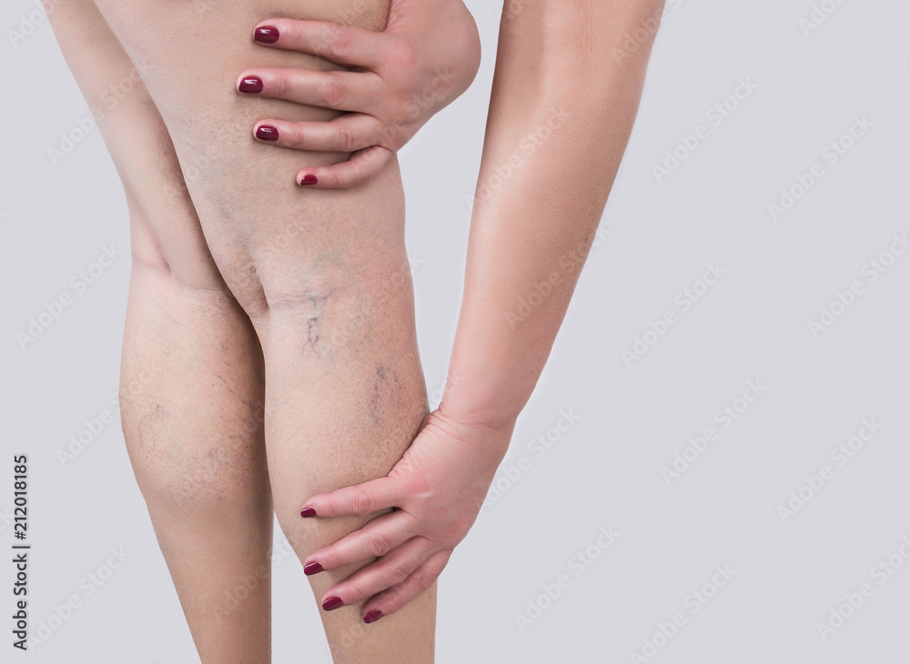 The varicose veins on a legs of woman - obrazy, fototapety, plakaty 