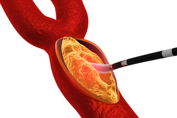 Wall Mural - Cholesterol plaque in artery. Removing plaque