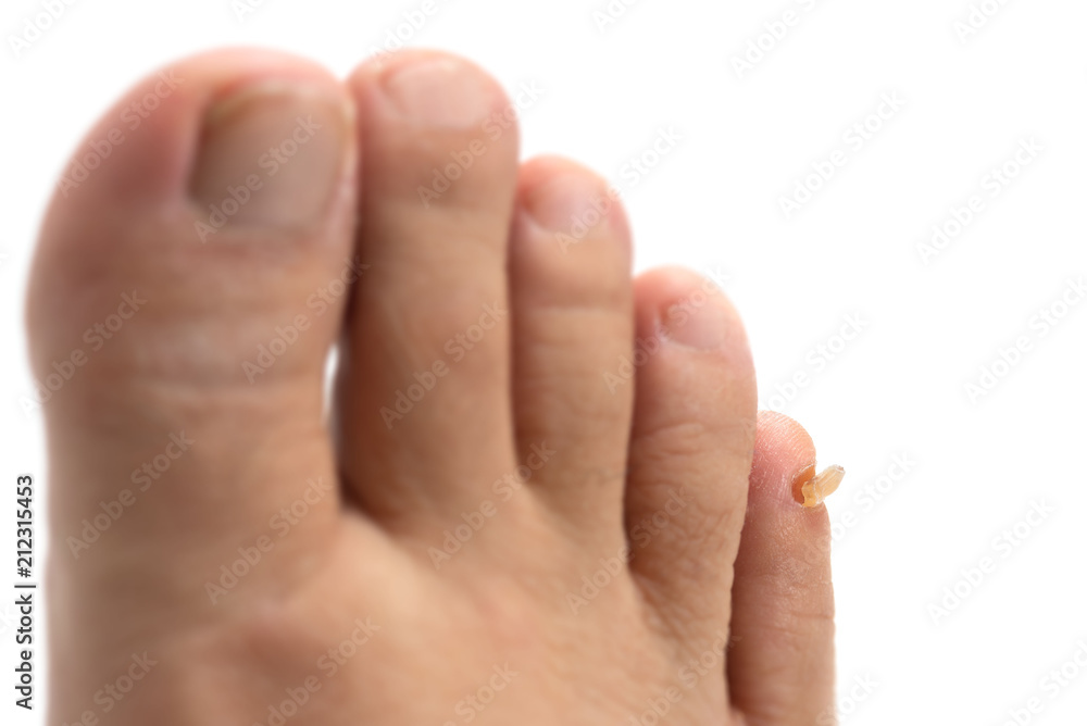 剥がれた足の爪 Wall Mural Wallpaper Murals Wallsheaven Caito