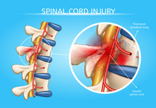 Human Spinal Cord Injury Anatomical Vector Scheme