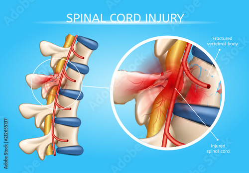 Fotografía Human Spinal Cord Injury Anatomical Vector Scheme