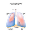 pneumothorax. Collapsed lung.