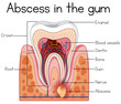 Abscess in the Gum Diagram