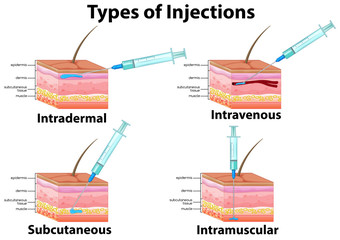 Canvas Print - A Set of Type of Injections