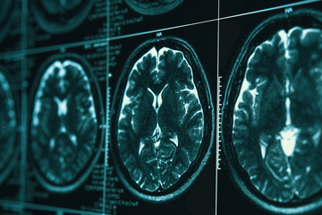 MRI or magnetic resonance image of head and brain scan. Close up view