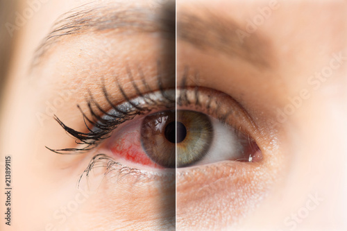 Cuadros en Lienzo Woman red eye before and after treatment