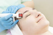 © lester120 - The woman undergoes the procedure of medical micro needle therapy with a modern medical instrument derma roller