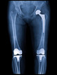 Xray scan of patient who have hip replacement and knee arthroplasty (knee replacement) treatment for Osteoarthritis knee, hip arthritis, Osteonecrosis of Hip. After surgery patient can walk normally