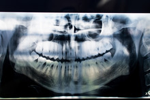 X-ray Of A Mouth With All Visible Teeth And Cavity In Evidence. Orthopanoramic Radiographt At The Dentist With Caries And Fillings Showned By The Doctor. Teeth Image.