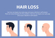 Stages of male pattern baldness. Hair loss. Alopecia. Asian men. Vector Flat Illustration