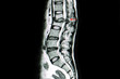 MRI scan of lumbar spines of a patient with kyphosis and back pain showing herniated disc from spondylodiscitis most likely from an infection such as staphylococci or mycobacteria.