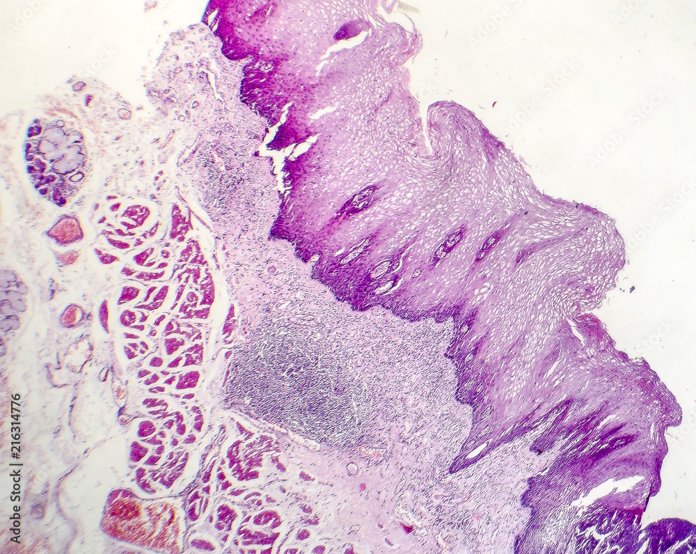 Squamous Cell Microscope Squamous cell carcinoma, light micrograph, photo under microscope Stock ...