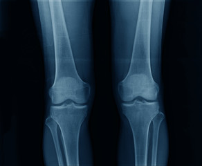 Wall Mural - x-ray image knee frontal show loss space of knee