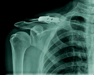 Canvas Print - x-ray clavicle fracture with post operation fixation