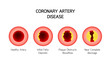 Coronary Artery Disease infographic. Heart awareness concept. Atherosclerosis stages in artery caused by cholesterol plaque. Vector illustration isolated on white background.