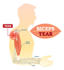 Wall Mural - Biceps tear vector illustration. Labeled medical scheme with humerus, muscle, radius and ulna isolated closeup. Anatomical diagram with human arm, elbow and shoulder.