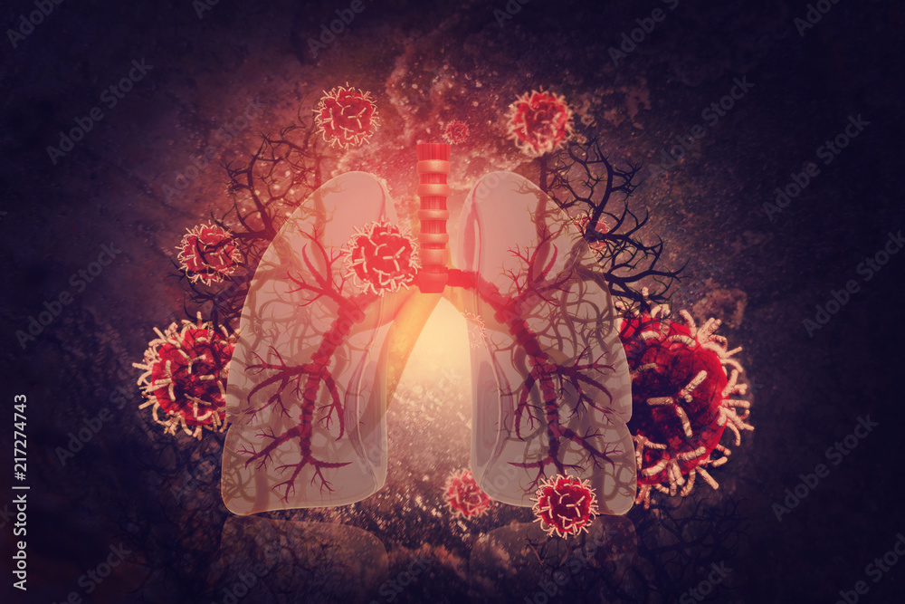 Virus and bacteria infected the Human lungs. lung disease - obrazy, fototapety, plakaty 