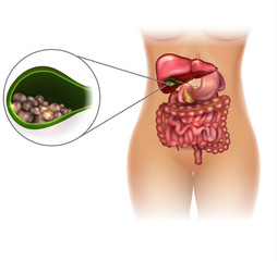 Poster - Gallstones in the Gallbladder female silhouette bright detailed illustration