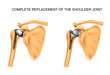 the types of prosthesis of shoulder