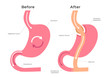 Gastric Bypass vector / stomach anatomy