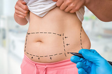 Plastic Surgery Doctor Draw Lines With Marker On Patient Belly