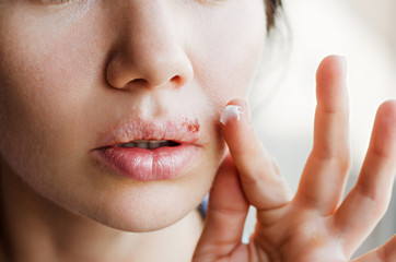 Part of a young woman's face with a virus herpes on lips, treatment with ointment