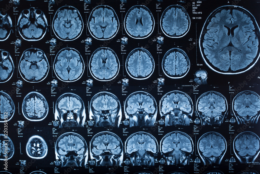 The X-ray of the human brain Stock Photo | Adobe Stock