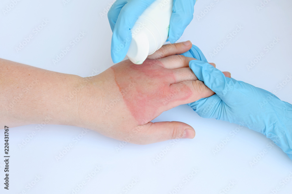 Doctor's hands holding female hand with second degree burns on white ...