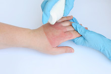 Doctor's Hands Holding Female Hand With Second Degree Burns On White Background. Treatment Of Burns By Spray. Patient Cheering And Support