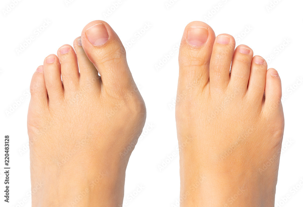Woman feet before and after surgery for hallux valgus removal - obrazy, fototapety, plakaty 