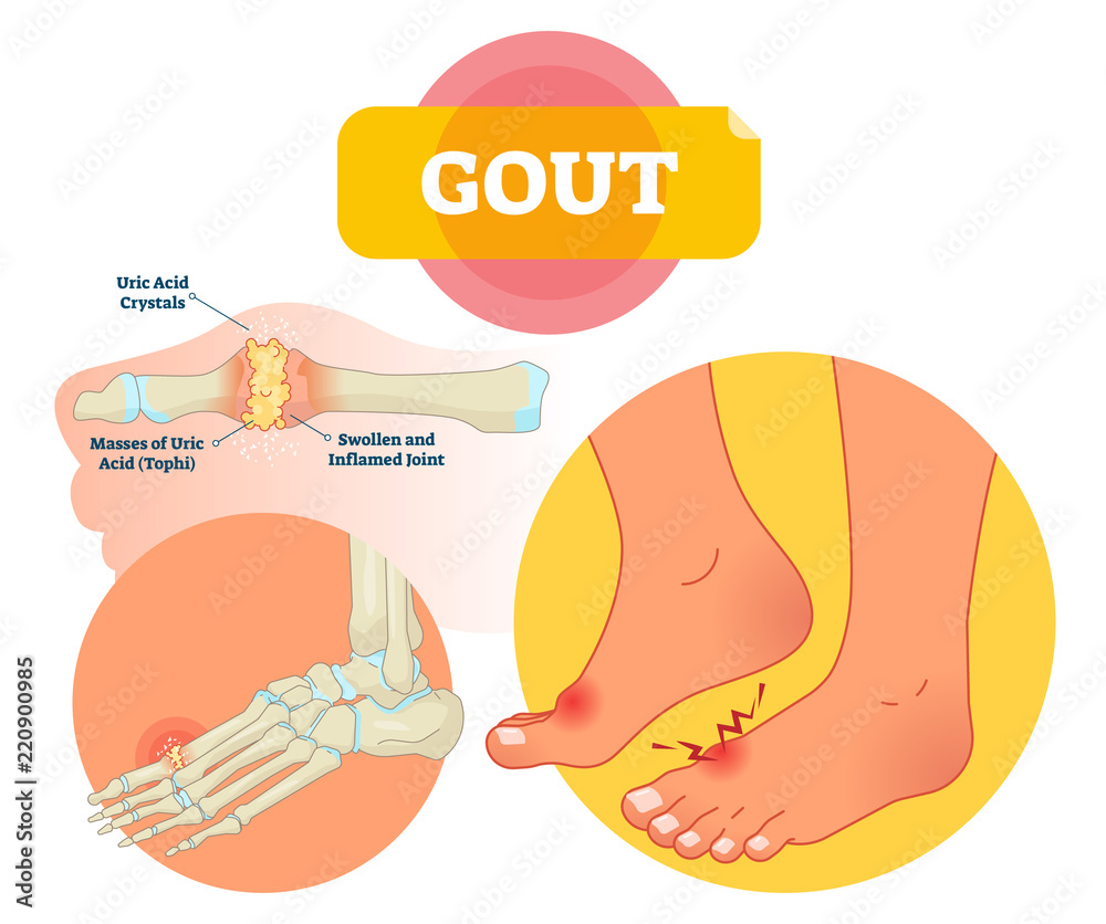 Gout vector illustration. Swollen and inflamed joint labeled scheme ...