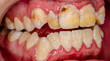© Dirk - serious dental plaque, frontal teeth intraoral