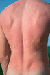 © majivecka - Male back burned from the sun.