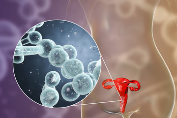 Wall Mural - Vaginal thrush, female candidiasis, 3D illustration showing fungal vaginitis and close-up view of yeast fungi Candida