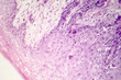 Cutaneous squamous cell carcinoma, light micrograph, photo under microscope