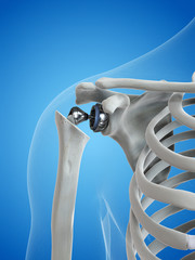 Wall Mural - 3d rendered medically accurate illustration of a shoulder replacement