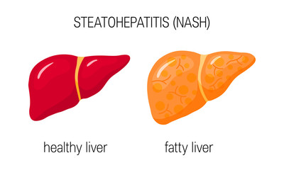 Wall Mural - Non-alcoholic steatohepatitis vector concept