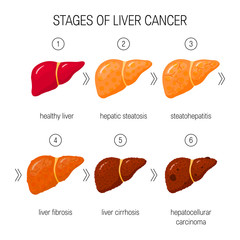 Wall Mural - Liver damage vector concept