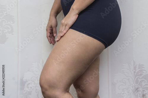 Fotografie, Obraz estética, mulher, coxa, biomedicina, corpo, pernas, injeção, varizes, jovem, saú
