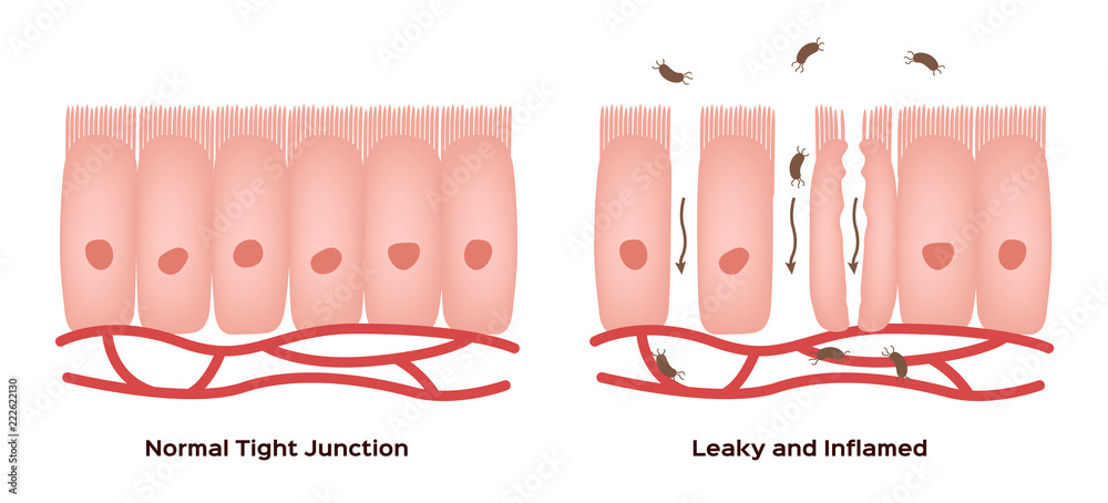 Celiac disease Small intestine lining damage. good and damaged villi ...