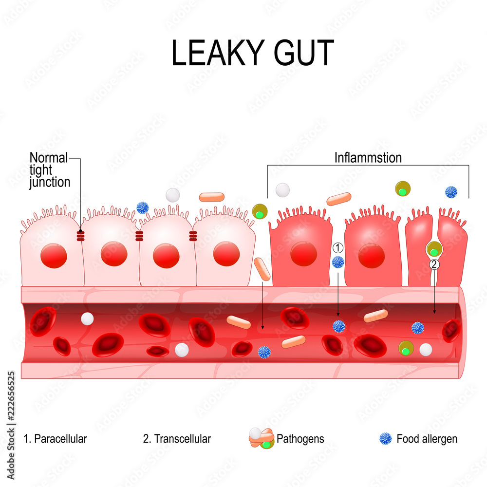 leaky gut - obrazy, fototapety, plakaty 