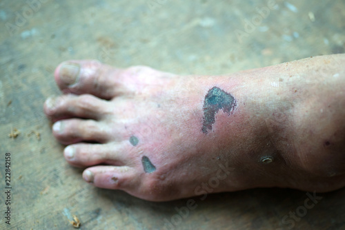 Fotografie, Obraz Inflammation swelling at the feet of people.