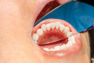 Wall Mural - close-up of human mouth teeth after professional whitening in the dental office. The concept of a healthy smile