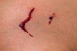 © fullmoonnarak - Bleeding wound in the leg