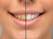 © Alessandro Grandini - Before and after teeth whitening treatment