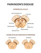 Midbrain anatomy. Parkinson's disease