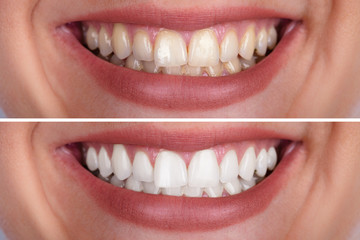 woman's teeth before and after whitening